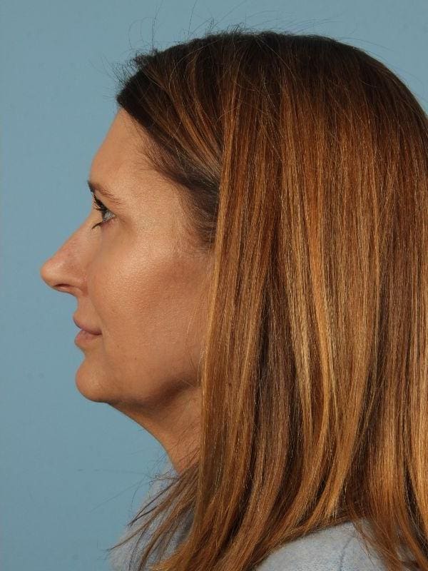 Injectable Fillers Patient Photo - Case 14665 - after view-1