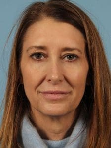 Dermal Fillers - Case 14665 - After