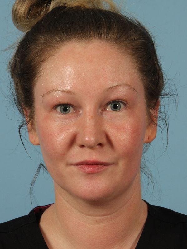 Injectable Fillers Patient Photo - Case 14677 - before view-