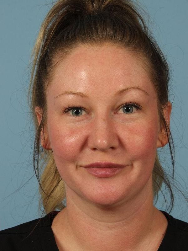 Injectable Fillers Patient Photo - Case 14677 - after view