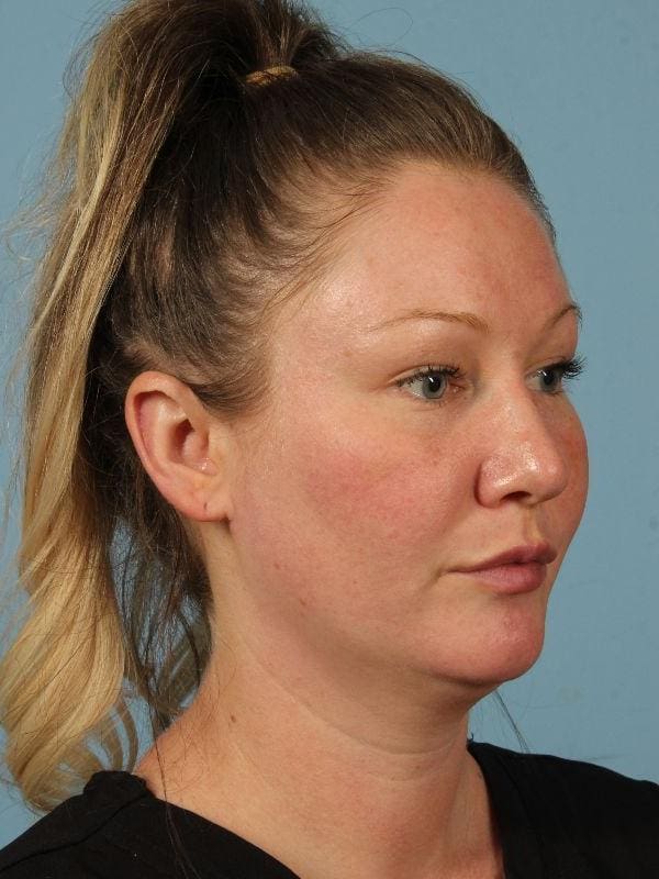 Injectable Fillers Patient Photo - Case 14677 - after view-1