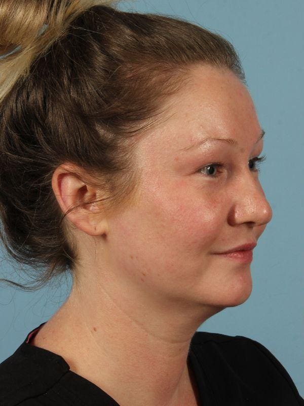 Injectable Fillers Patient Photo - Case 14677 - before view-1