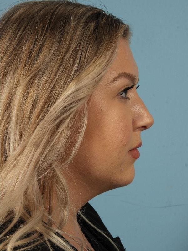 Injectable Fillers Patient Photo - Case 14683 - after view-2