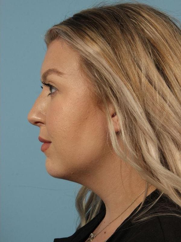 Injectable Fillers Patient Photo - Case 14683 - after view-1