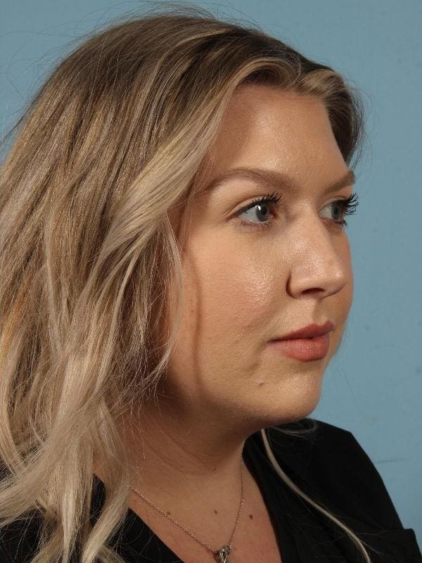 Injectable Fillers Patient Photo - Case 14683 - after view-3