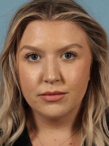 Dermal Fillers - Case 14683 - After