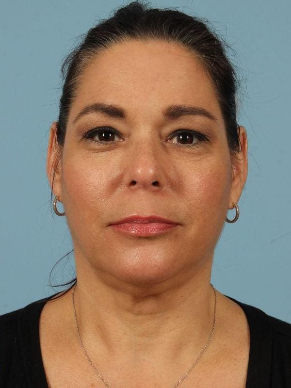 Dermal Fillers Patient Photo - Case 14693 - after view