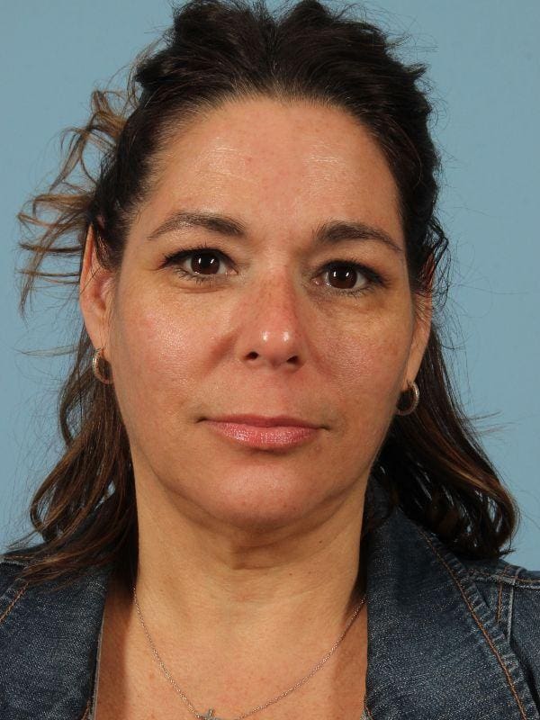 Dermal Fillers Patient Photo - Case 14693 - before view-