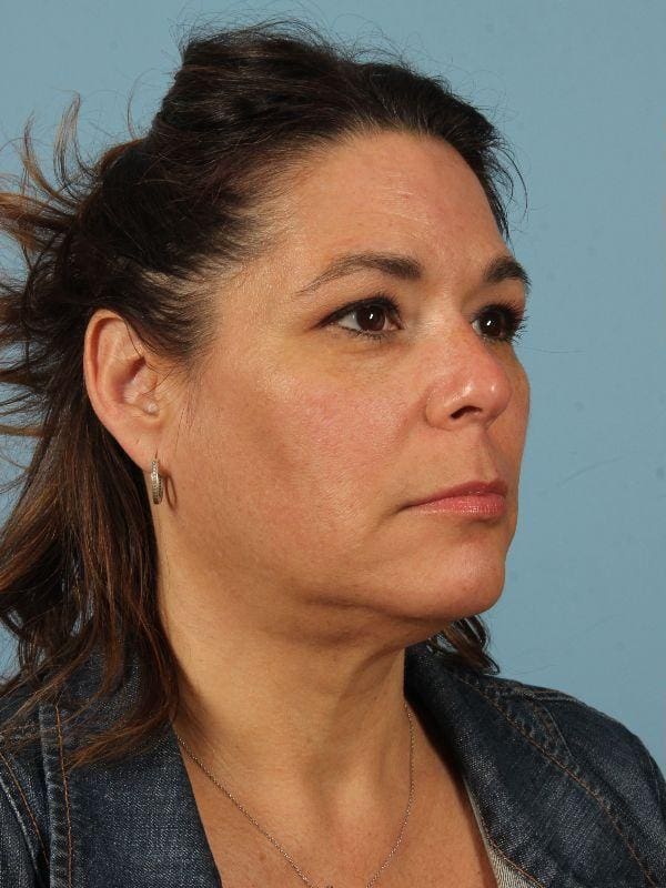 Dermal Fillers Patient Photo - Case 14693 - before view-1
