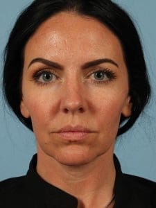 Dermal Fillers - Case 14699 - Before