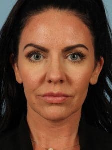 Dermal Fillers - Case 14699 - After