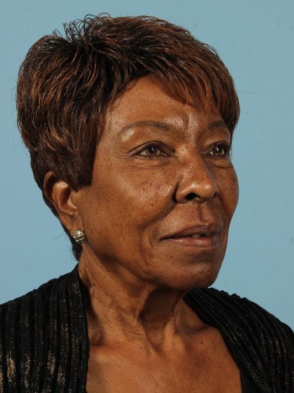 Injectable Fillers Patient Photo - Case 14705 - after view-3