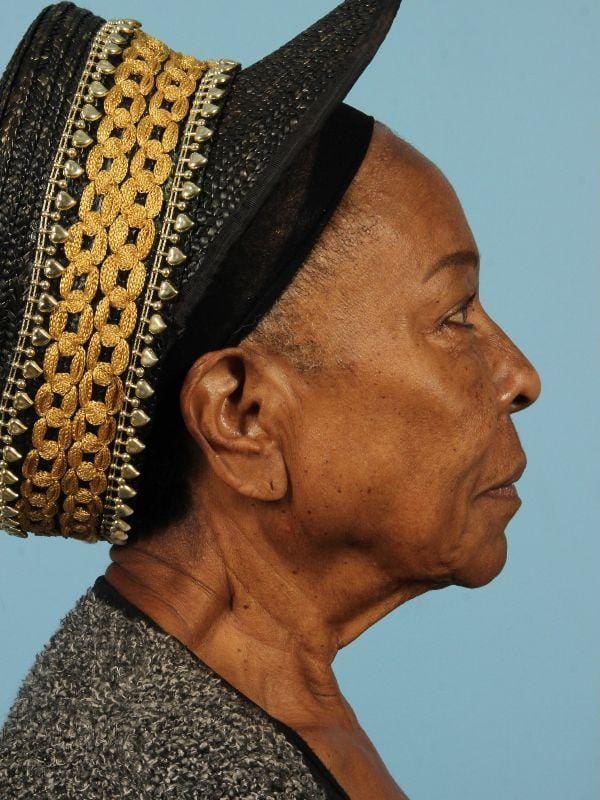 Injectable Fillers Patient Photo - Case 14705 - before view-2