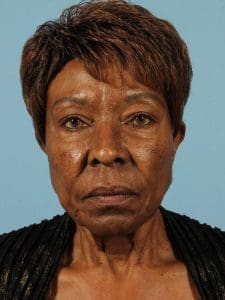 Dermal Fillers - Case 14705 - After