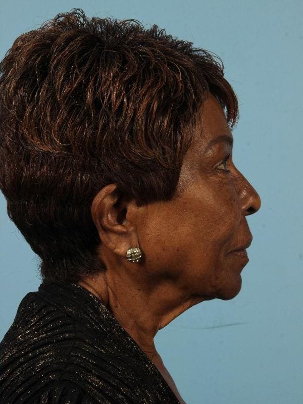 Injectable Fillers Patient Photo - Case 14705 - after view-2