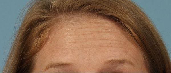 Dermal Fillers Patient Photo - Case 14715 - after view-1