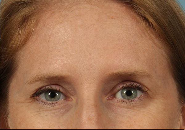 Dermal Fillers Patient Photo - Case 14715 - after view-2