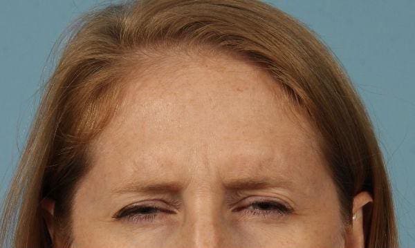 Dermal Fillers Patient Photo - Case 14715 - after view