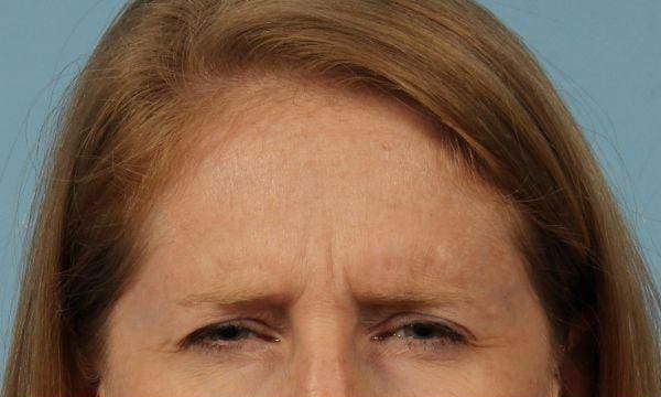 Dermal Fillers Patient Photo - Case 14715 - before view-