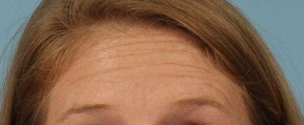 Dermal Fillers Patient Photo - Case 14715 - before view-1