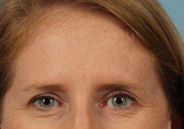 Dermal Fillers Patient Photo - Case 14715 - before view-2