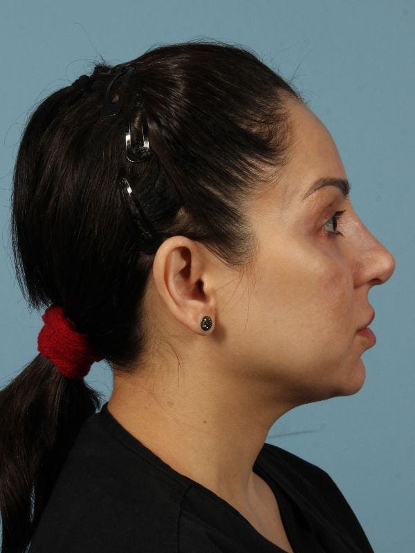 Dermal Fillers Patient Photo - Case 14723 - before view-2