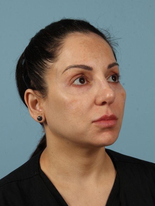 Dermal Fillers Patient Photo - Case 14723 - before view-4