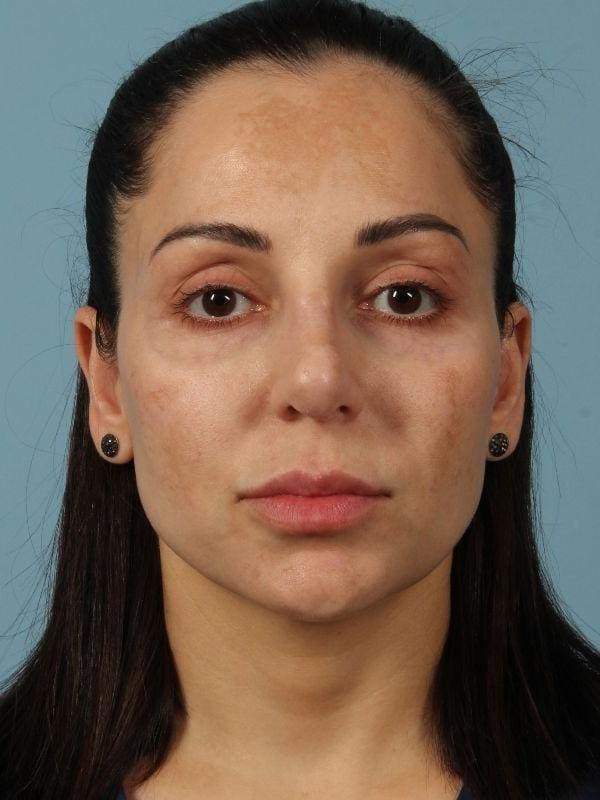 Dermal Fillers Patient Photo - Case 14723 - after view