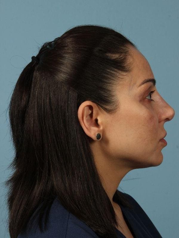 Dermal Fillers Patient Photo - Case 14723 - after view-2