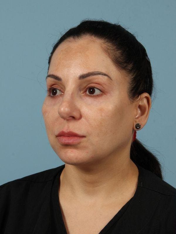 Dermal Fillers Patient Photo - Case 14723 - before view-3