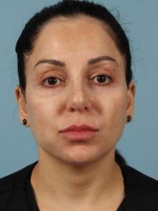 Dermal Fillers - Case 14723 - Before