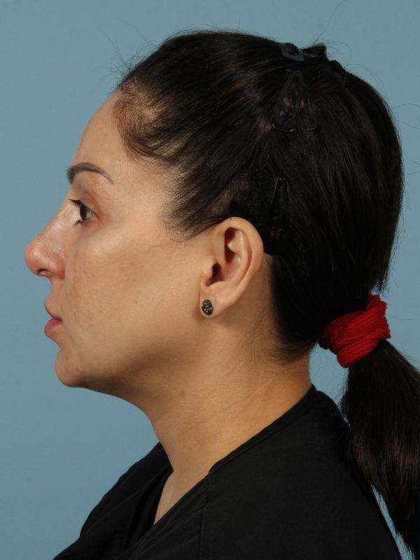 Dermal Fillers Patient Photo - Case 14723 - before view-1