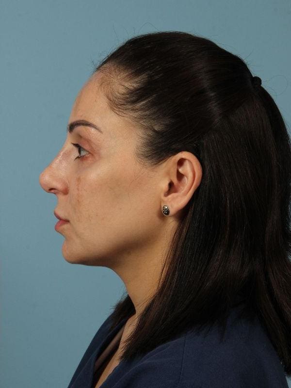 Dermal Fillers Patient Photo - Case 14723 - after view-1