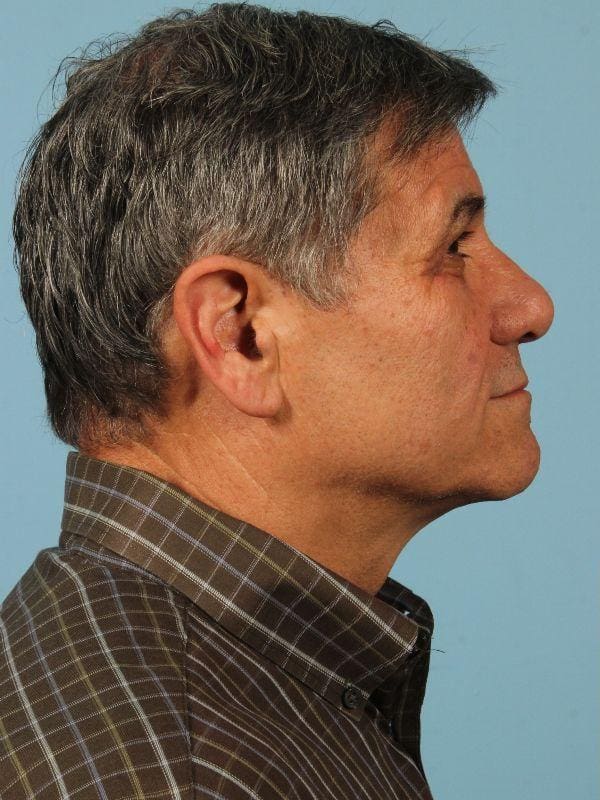 Injectable Fillers Patient Photo - Case 14735 - before view-2