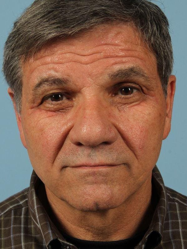 Injectable Fillers Patient Photo - Case 14735 - before view-