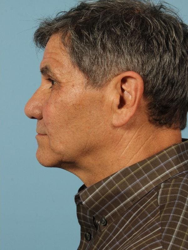 Injectable Fillers Patient Photo - Case 14735 - after view-1