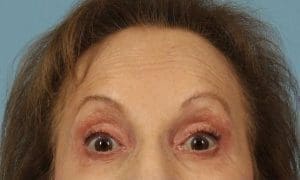 Dermal Fillers - Case 14752 - After
