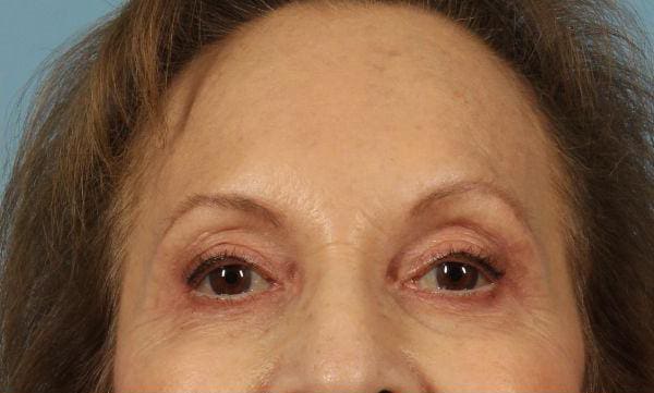 Dermal Fillers Patient Photo - Case 14752 - after view-1