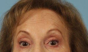 Dermal Fillers - Case 14752 - Before