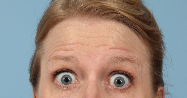 Injectable Fillers Patient Photo - Case 14758 - before view-1