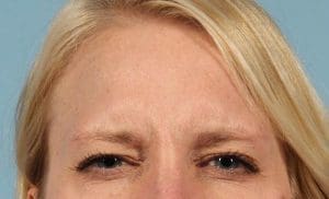 Dermal Fillers - Case 14758 - After