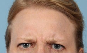 Dermal Fillers - Case 14758 - Before