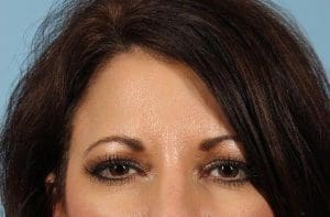 Dermal Fillers - Case 14765 - After
