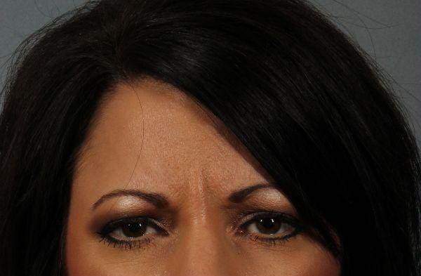 Dermal Fillers Patient Photo - Case 14765 - before view-