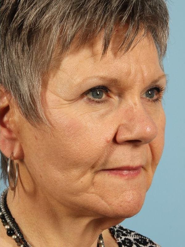 Injectable Fillers Patient Photo - Case 14772 - after view-1