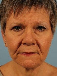 Dermal Fillers - Case 14772 - Before