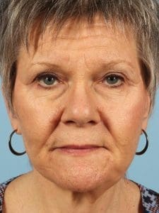 Dermal Fillers - Case 14772 - After