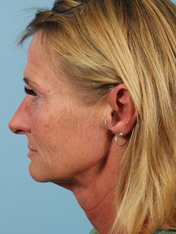 Dermal Fillers Patient Photo - Case 14779 - before view-1