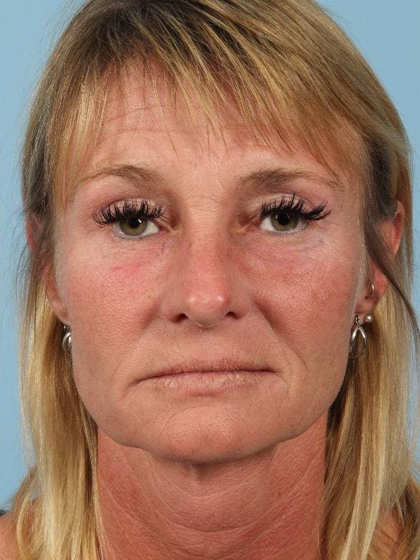 Dermal Fillers Patient Photo - Case 14779 - after view