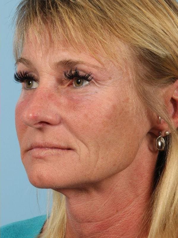 Dermal Fillers Patient Photo - Case 14779 - after view-2